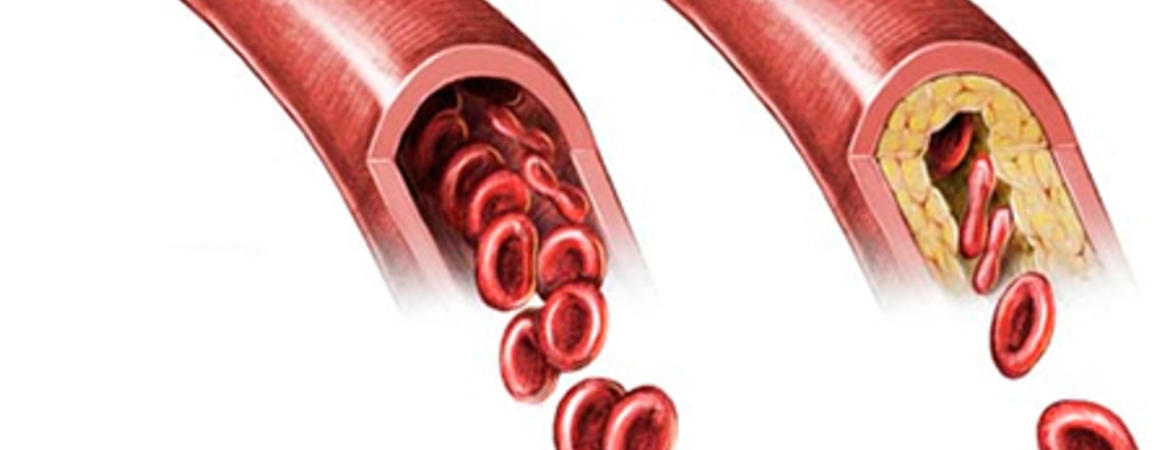 cerebral atherosclerosis