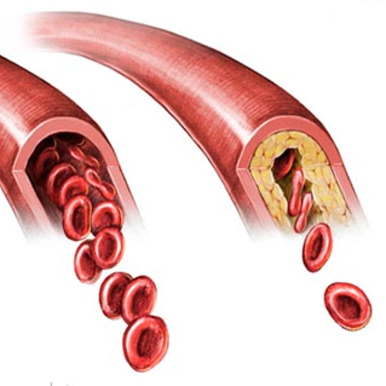 cerebral atherosclerosis